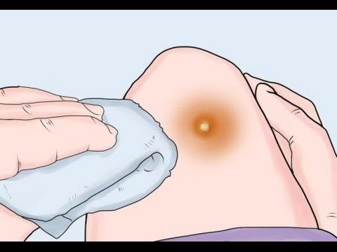 Remedios caseros para los forúnculos