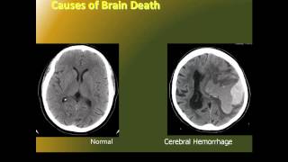 diagnosis of brain death