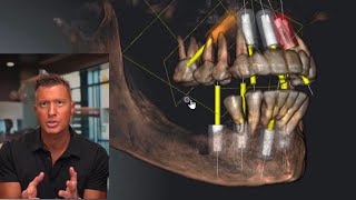 Full Mouth 👄 Dental 🦷 Implants saved the failing Bridge!