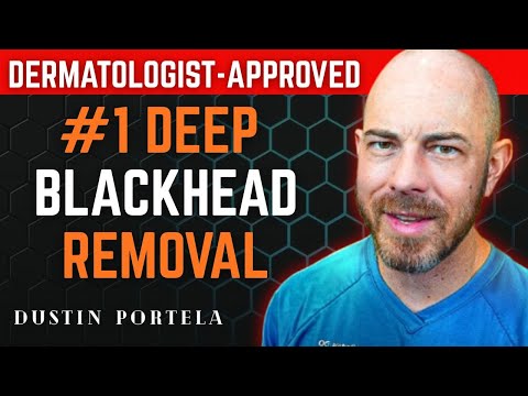 The #1 Dermatologist-Approved Method for Deep Blackhead Removal at Home” | Dustin Portela