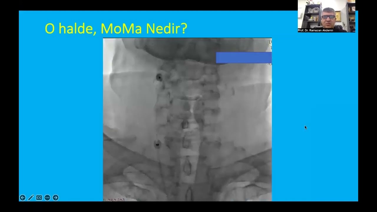 Şah Damar(Karotis Arter) Hastalığı Tedavisi: MoMa Nedir?