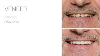 Ein neues Lächeln mit edelweiss VENEERs
