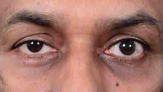 Ptosis Correction by Levator Reinsertion