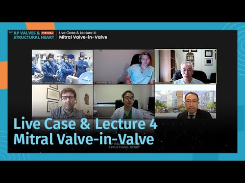 [AP VALVES & SH 2021] Live Case & Lecture 4: Mitral Valve-in-Valve