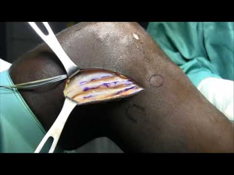 Tecnica chirurgica di ricostruzione del legamento anterolaterale del ginocchio