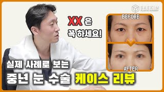 중년눈성형이 요즘 많아지는 이유는?? 중년눈성형 수술 케이스 리뷰로 확인하시죠!