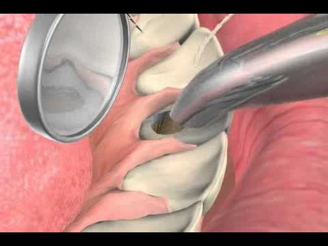 What can you do about a dark tooth - internal bleaching