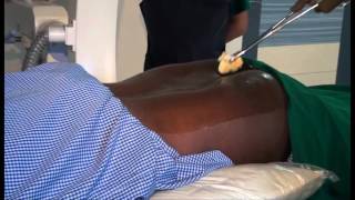 CAUDAL EPIDURAL INJECTION VIDEO - By Dr. Vicky Nevagi, Pain clinic of India, Goa Branch