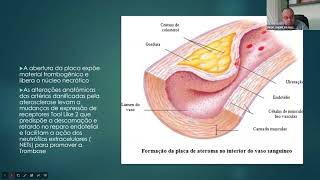 Síndrome Coronariana Aguda