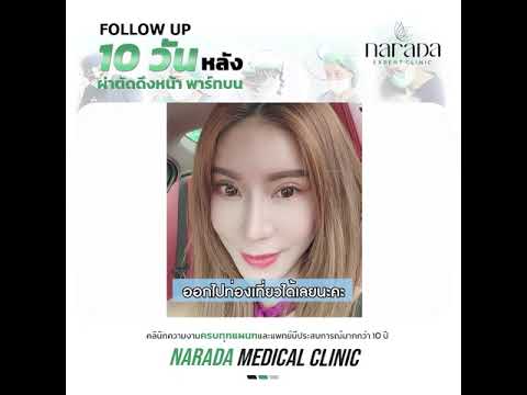 ติดตาผลการทำ Endo Face Lock ผ่าตัดดึงหน้า พาร์ทบน เทคนิคดึงทุกชั้นผิว 10 วัน ที่ นารดาคลินิก