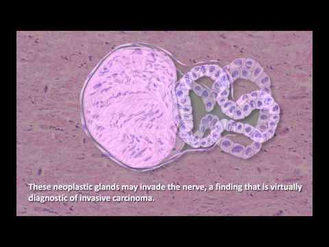 Kann ich aus dem Prostata Ultraschall entscheiden Mit einer Verschlimmerung der Prostatitis diagnostiziert