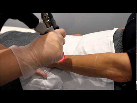 RevLite Laser Hair Removal on arm at Sure Aesthetics
