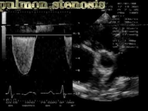 Ciężka stenoza zastawki pnia płucnego: nagrania z metody dopplera fali ciągłej