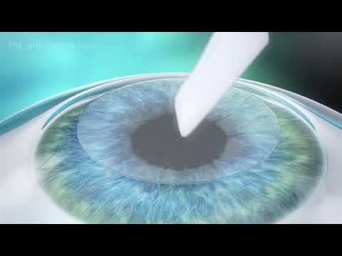 Lasek (Laser epithelial keratomileusis)