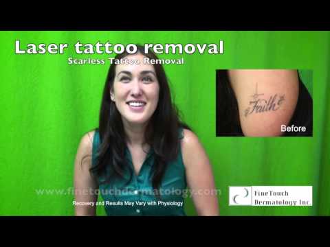 Laser Tattoo Removal: Before and After of Scarless Tattoo Removal on Glendale Patient