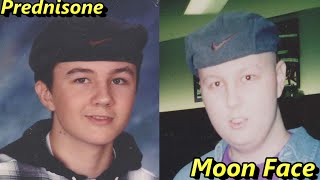Prednisone Moon Face - Survivor Christopher