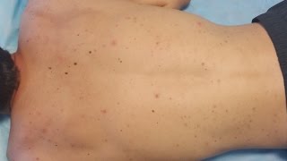 Acne Treatment on the Back (Infected Lesions)