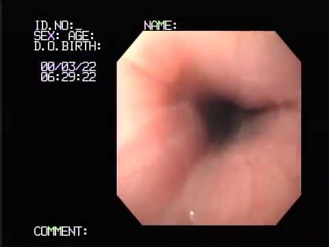 Buccia di faccia laser e meccanica Ringiovanimento di faccia da iniezioni