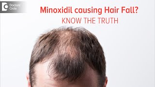 KNOW THE TRUTH | Does Minoxidil Solution cause Hair Fall?- Dr. Deepak P Devakar | Doctors
