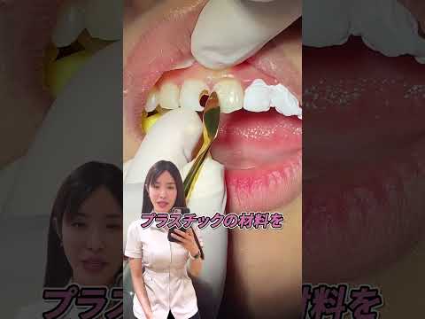 虫歯で空いた歯の穴の治し方を解説します！ #歯医者 #虫歯 #ダイレクトボンディング