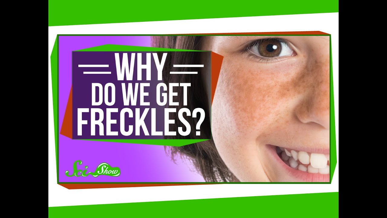 Why Do We Get Freckles? thumnail