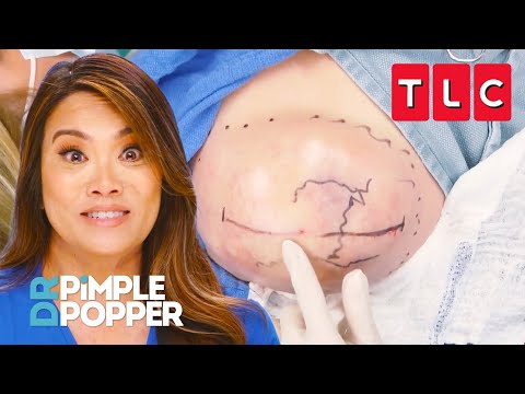 All the Pops from Season 9 Part 1 | Dr. Pimple Popper | TLC