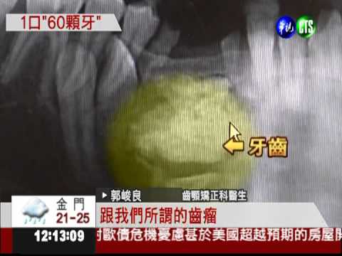 長得不整齊! 國中生牙齒多一倍