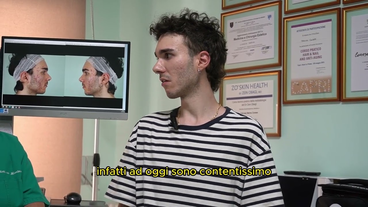HO SCONFITTO L'ACNE!! La testimonianza di Angelo