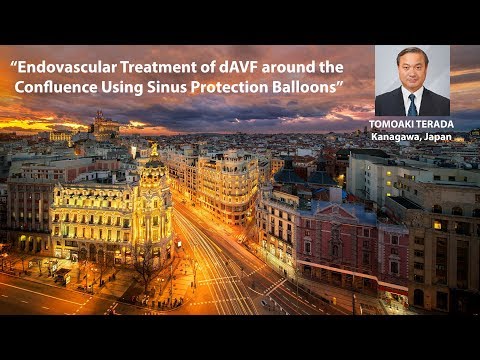 Endovascular Treatment of dAVF around the confluence Using Sinus Protection Balloons
