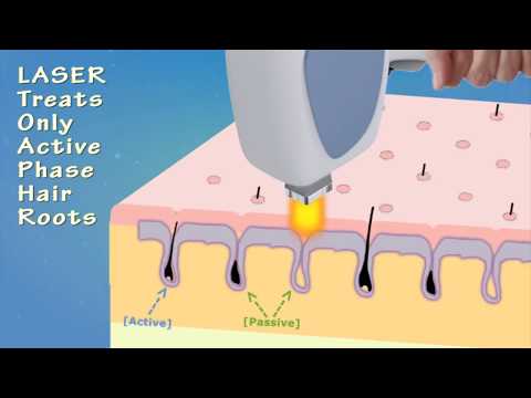 download lagu mp3 mp4 After Laser Hair Removal Does The Hair Fall Out, download lagu After Laser Hair Removal Does The Hair Fall Out gratis, unduh video klip After Laser Hair Removal Does The Hair Fall Out