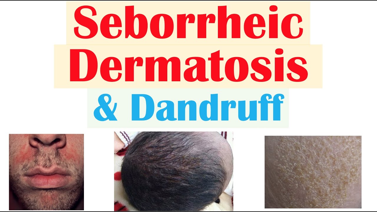 Seborrheic Dermatitis (Dandruff and Cradle Cap) Causes, Risk Factors, Symptoms, Diagnosis, Treatment