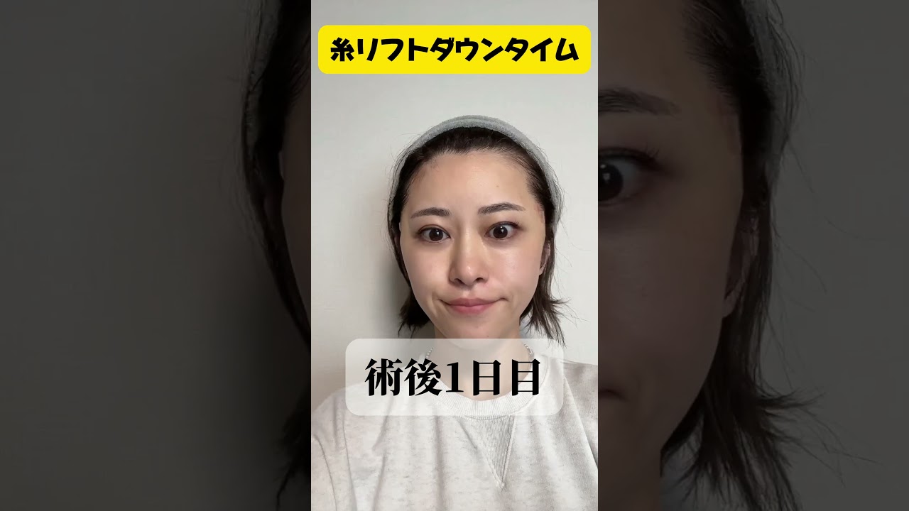 【40歳糸リフト受けてきた】直後から腫れはほとんどないし、内出血もほぼなし！糸リフトならBRIGHTS beauty clinicのドクター今村にお任せ✨#short #たるみ治療 #美容