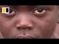 Mpox declared a global emergency, but how serious is it?