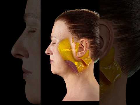 Deep plane facelift and neck lift ✨ #facelift #necklift #deepplanefacelift #kaminskyi