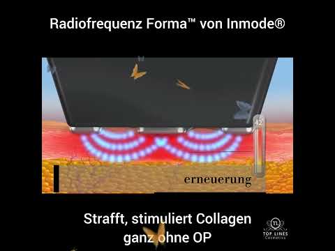 Radiofrequenz Lifting