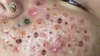 Loan Nguyen Acne Treatment 2m