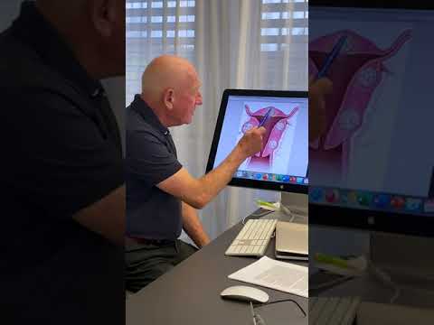 Behandlung von Myomen