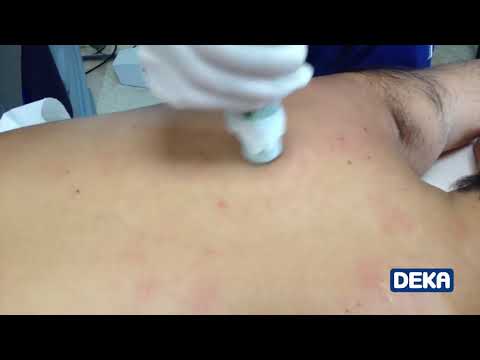 DEKA MOVEO technology  a new laser hair removal concept!