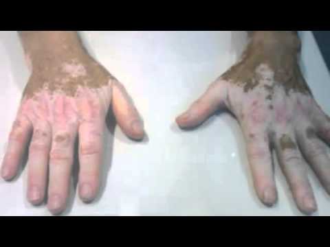 comment soigner psoriasis gland