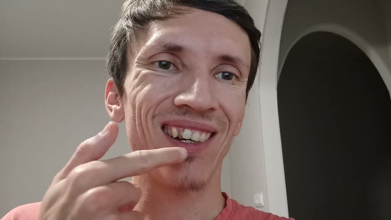 Установили культевую вкладку и поставили временную коронку