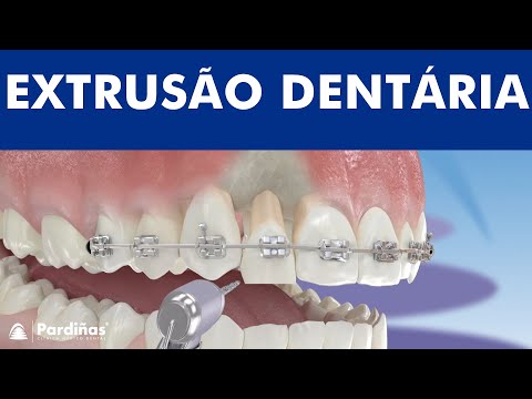 Extrusão dentária ©
