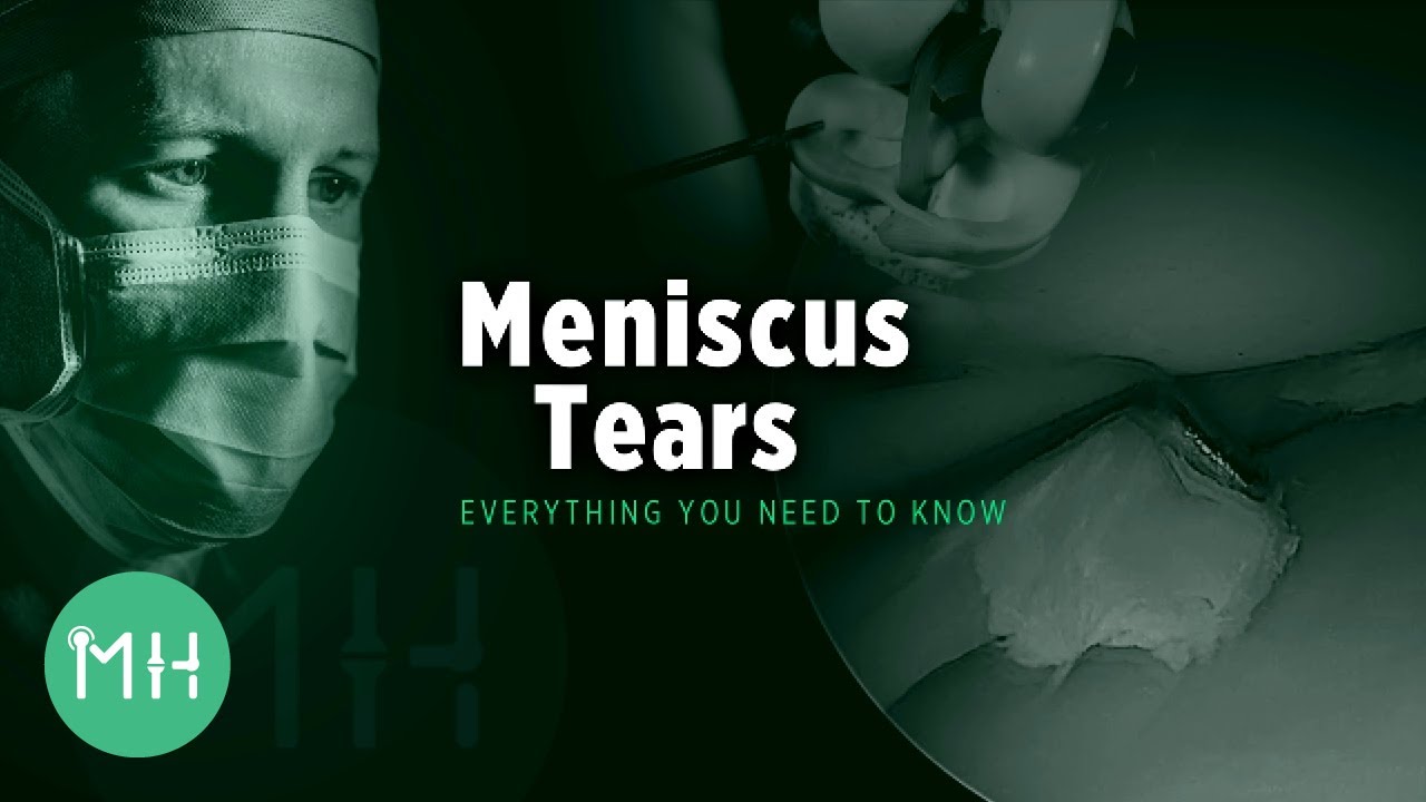 Meniscus Tears - Everything you need to know