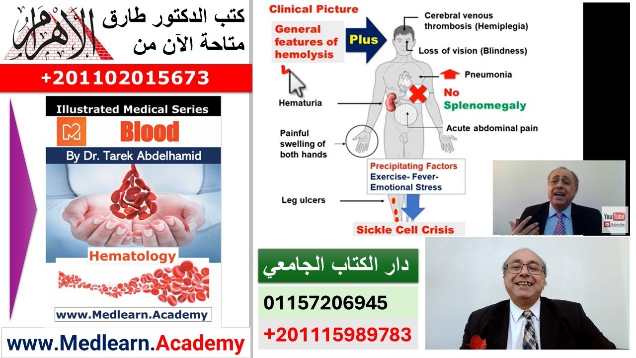 Sickle Cell Anemia   #cme #internal_medicine #medical #medicalstudent  #usmle #محاضرات_باطنة