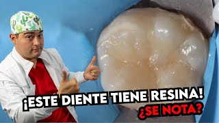 RESINAS DENTALES ANTES Y DESPUES ¿COMO DEBE QUEDAR UNA RESTAURACIÓN DENTAL CORRECTAMENTE
