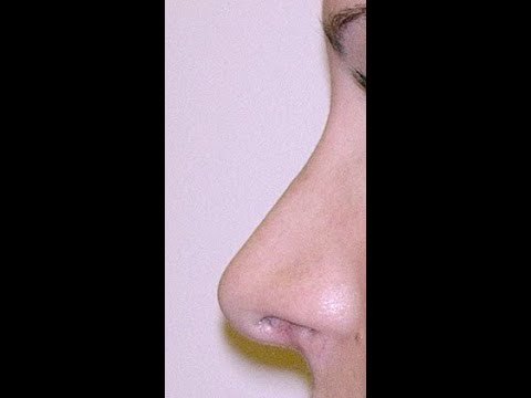 Εικόνα προεπισκόπησης βίντεο: Ρινοπλαστική & Ωτοπλαστική (ουδέτερη μικρογραφία)