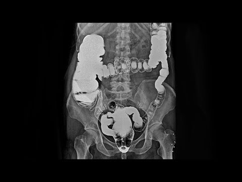 hyperopia 100% -os látásnál