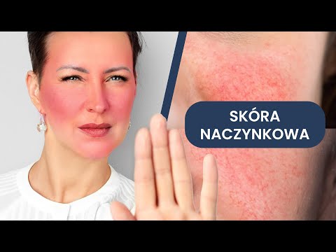 Jak pielęgnować skórę naczynkową? 47 kosmetyków + Schematy pielęgnacji dla SKÓRY NACZYNIOWEJ