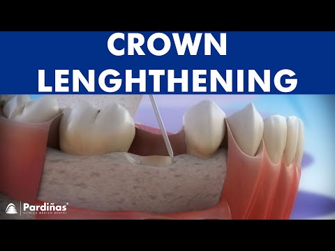 Dental crown lengthening ©