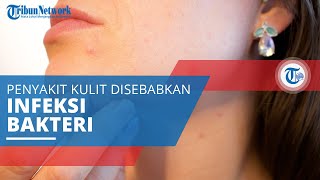 Impetigo, Penyakit Kulit yang Terjadi karena Infeksi Bakteri yang Menyebabkan Kulit Keluarkan Nanah
