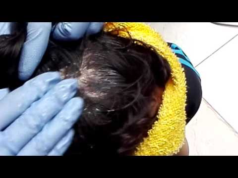 El tratamiento de la psoriasis netraditsionno Los ungüentos homeopáticos de la eccema